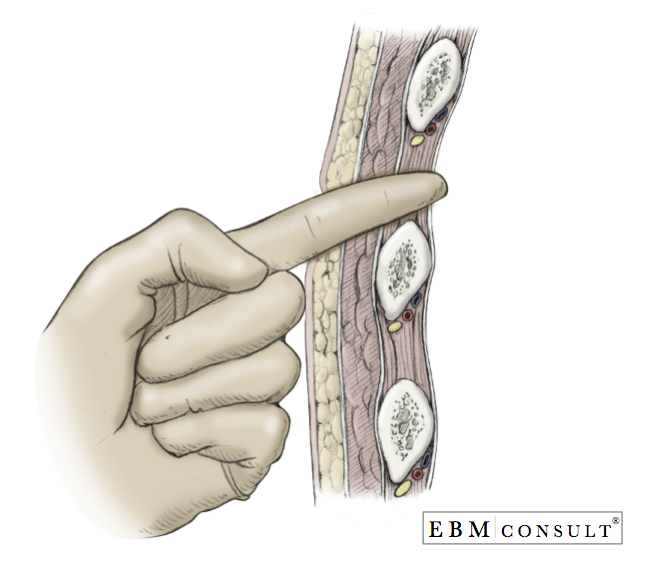 Chest Tube Placement Thoracostomy Procedure